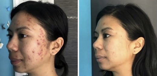 Micro needling Acne