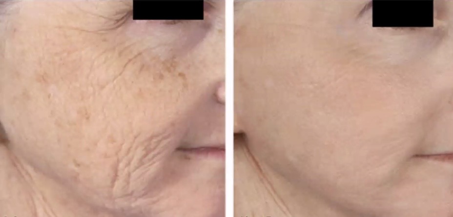 Micro needling improves facial spots and melasma