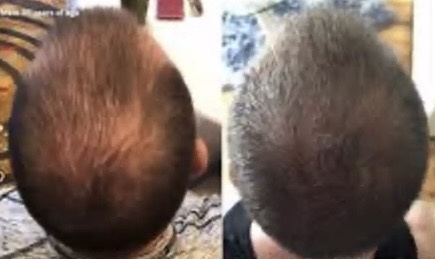Micro needling helps hair loss