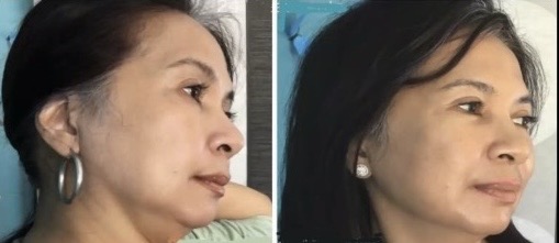 Micro needling Cosmetic Acupuncture